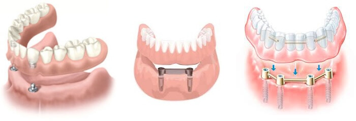 Sobredentadura sobre implantes dentales En qué consiste Clínica