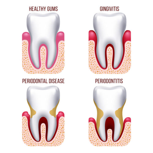 gingivitis-y-periodontitis-clinica-pfaff