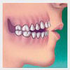 maloclusion-dental-abierta-solucion