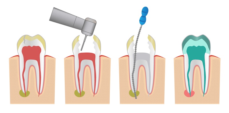 pasos-de-una-endodoncia pasos-de-una-endodoncia
