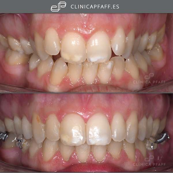 antes-y-despues-tratamiento-ortodoncia-brackets-barcelona-Pfaff-sant-gervasi-02 antes-y-despues-tratamiento-ortodoncia-brackets-barcelona-Pfaff-sant-gervasi-02