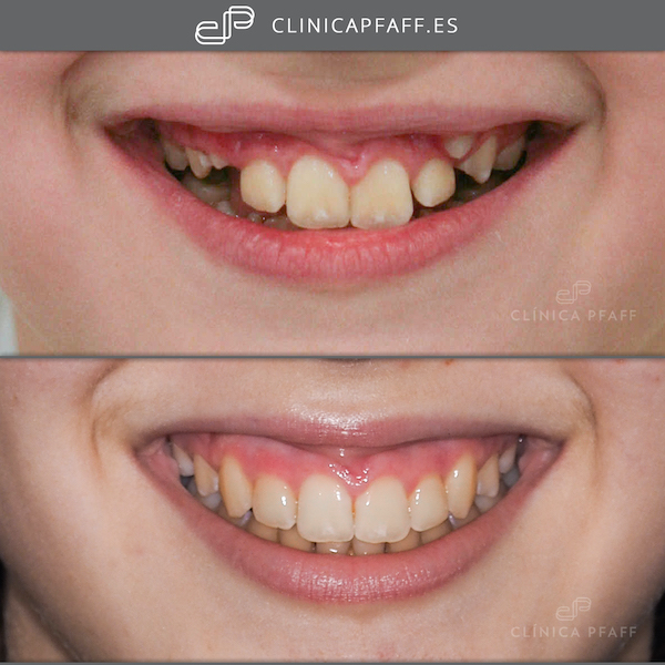 clinica-dental-tratamiento-ortodoncia-fija-brackets-barcelona-Pfaff-sant-gervasi-03 clinica-dental-tratamiento-ortodoncia-fija-brackets-barcelona-Pfaff-sant-gervasi-03