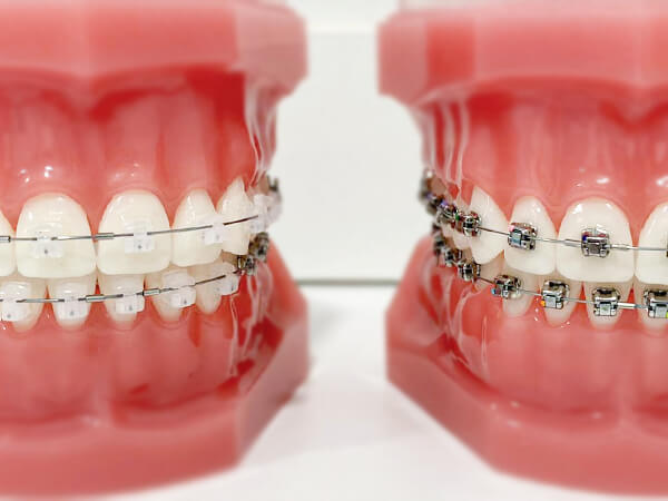 brackets-damon-de-autoligado-en-barcelona brackets-damon-de-autoligado-en-barcelona