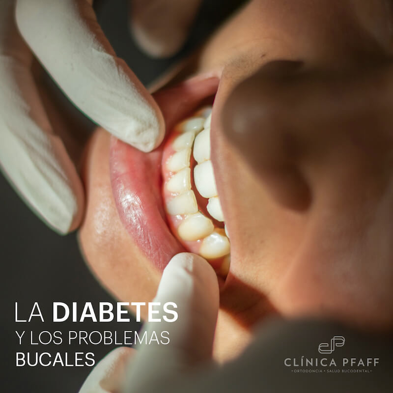 la-diabetes-y-los-problemas-bucales-barcelona-clinica-pfaff la-diabetes-y-los-problemas-bucales-barcelona-clinica-pfaff