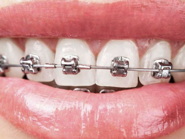 brackets-autoligado-barcelona brackets-autoligado-barcelona