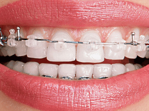 brackets-esteticos-ceramica-porcelana