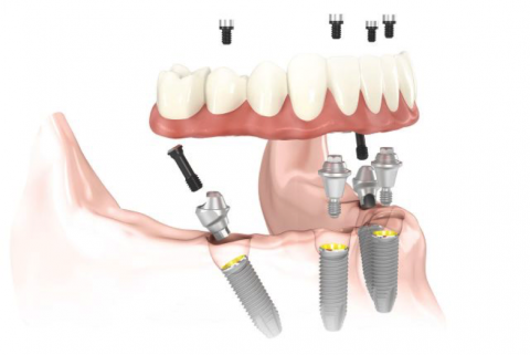 Implantes dentales all on 4 en Barcelona