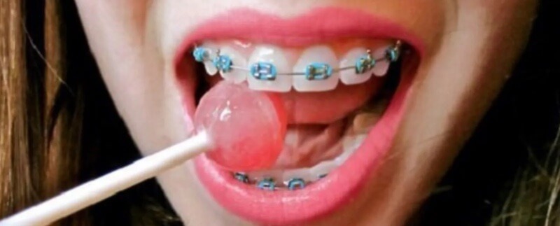 que-comer-con-brackets