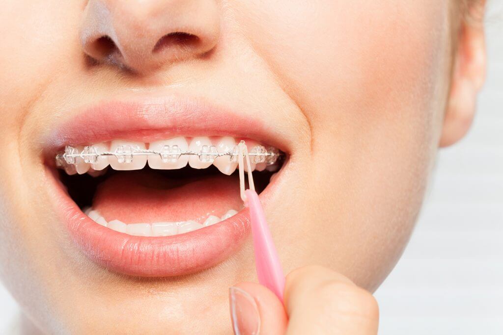 blanqueamiento-dental-con-brackets