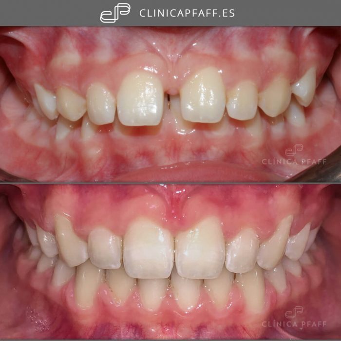 ortodoncia-invisalign-antes-despues ortodoncia-invisalign-antes-despues