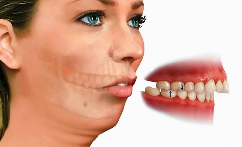 consecuencias-maloclusion-dental consecuencias-maloclusion-dental