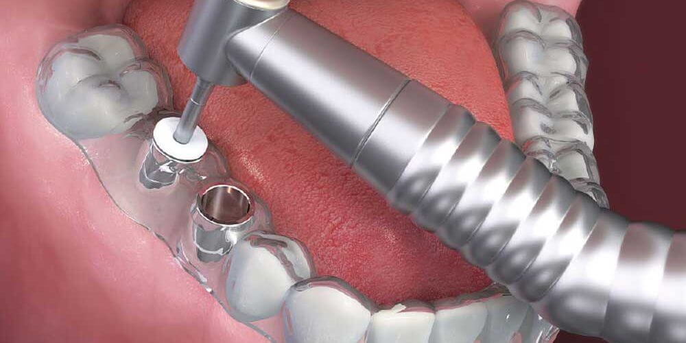 implantes-dentales-con-cirugia-guiada implantes-dentales-con-cirugia-guiada