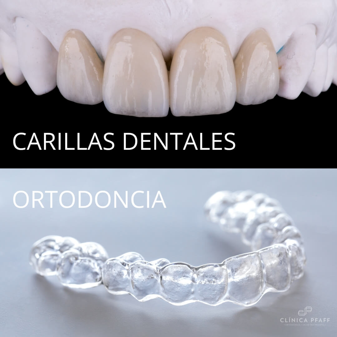 relacion-entre-carillas-dentales-y-ortodoncia-pfaff