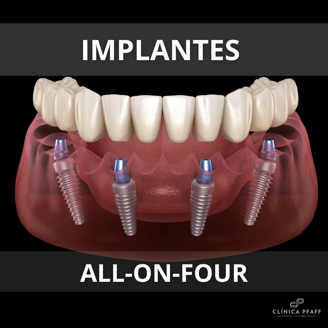 implantes-dentales-all-on-four-barcelona-pfaff