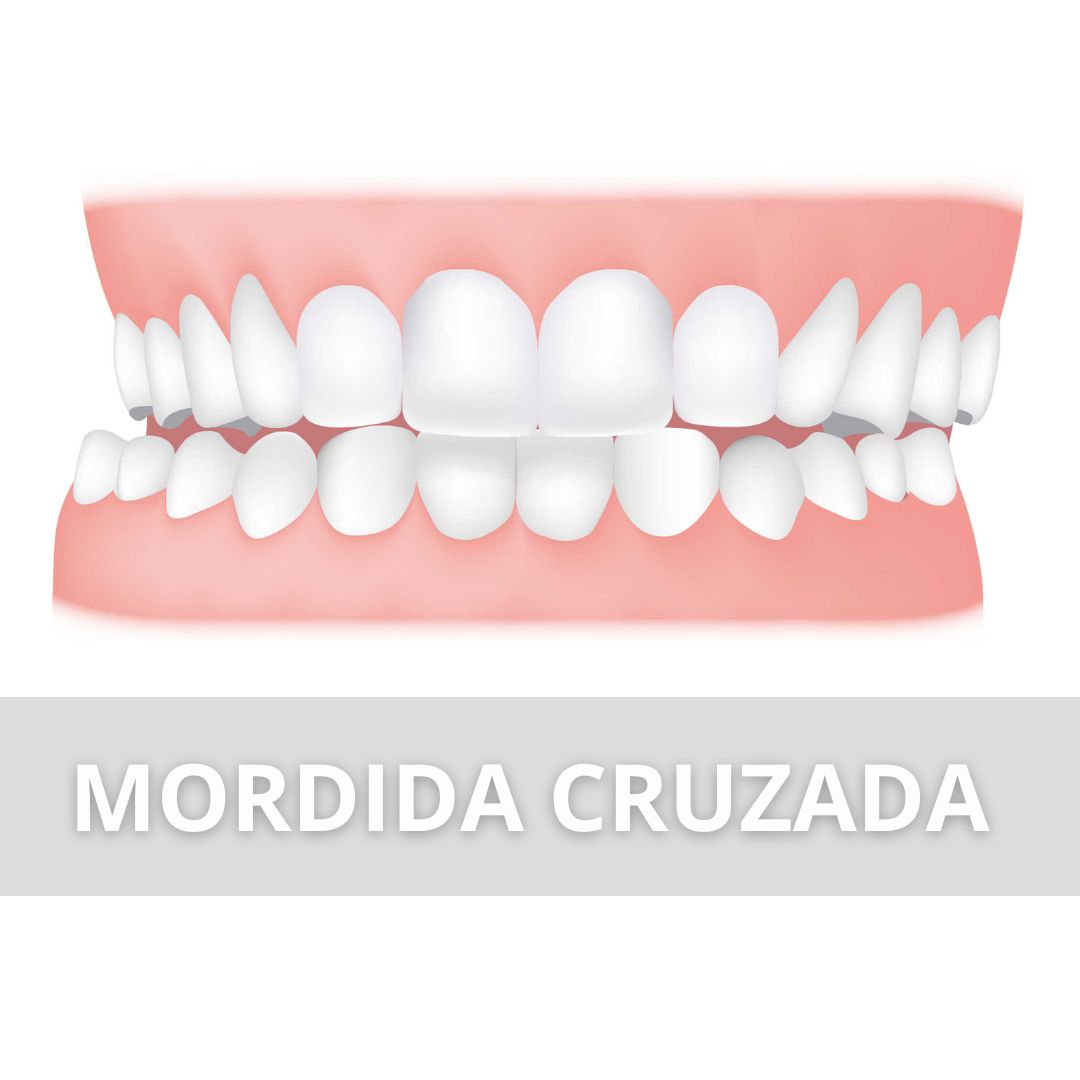 Mordida-Cruzada-ortodoncia-barcelona Mordida-Cruzada-ortodoncia-barcelona