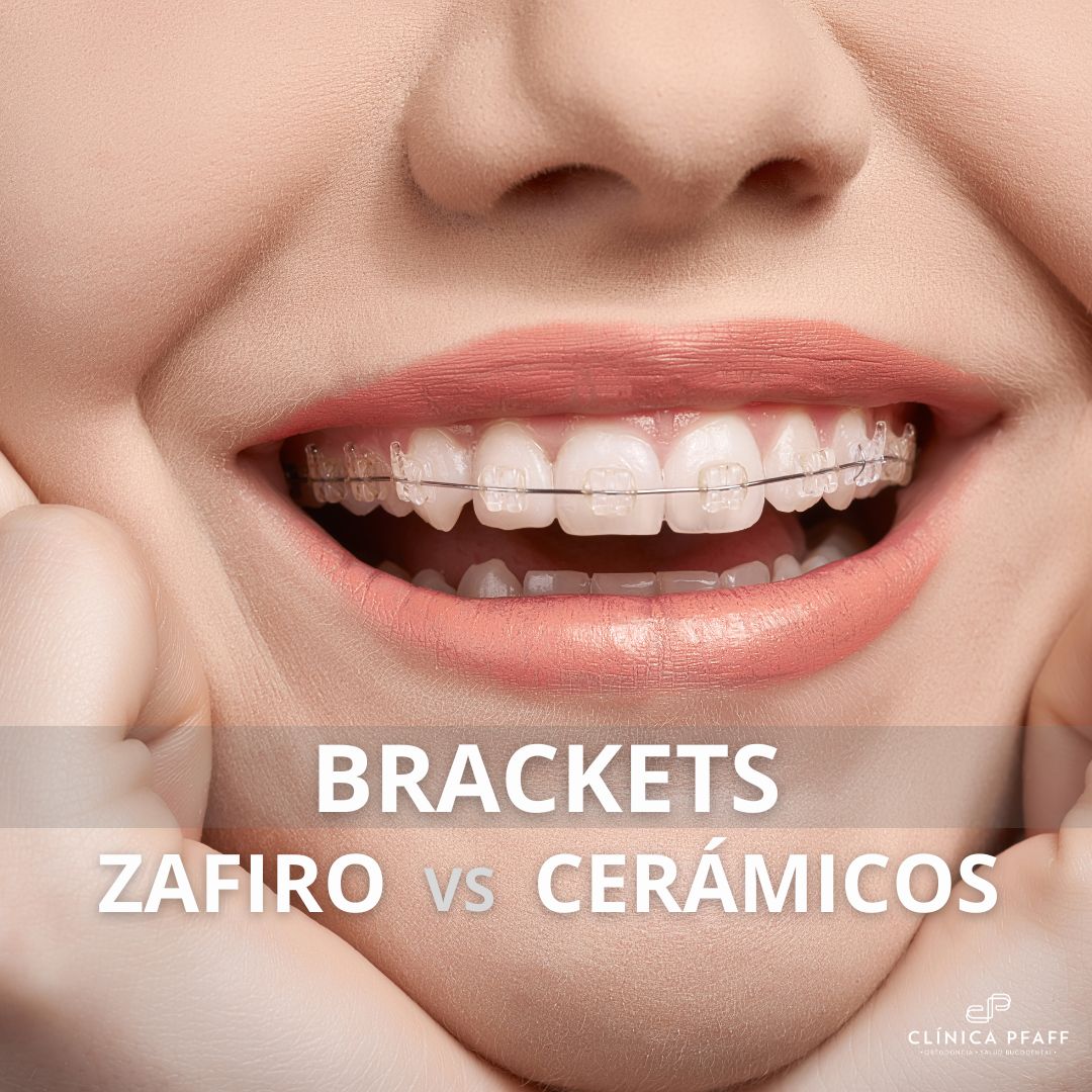 ortodoncia-brackets-zafiro-vs-ceramicos